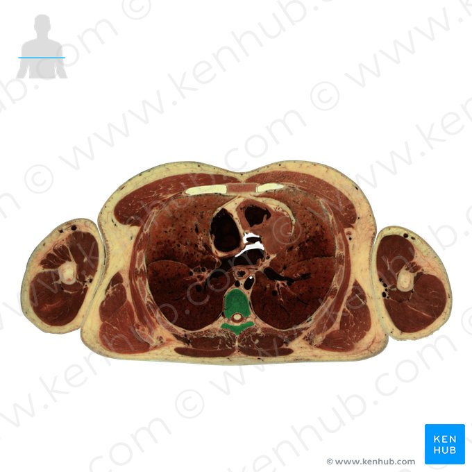 Vertebra T7; Image: National Library of Medicine