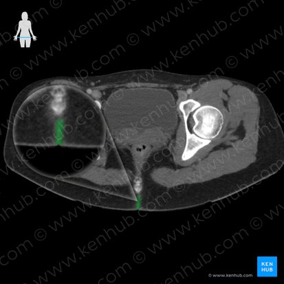 Hendidura interglútea (Crena interglutealis); Imagen: 