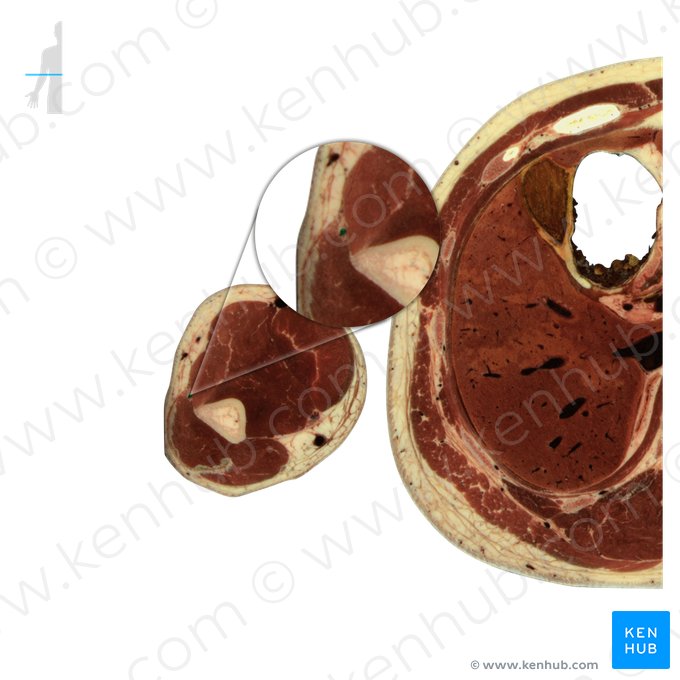 Artéria colateral radial (Arteria collateralis radialis); Imagem: National Library of Medicine