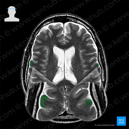 Gyrus precentralis (Vordere Zentralwindung); Bild: 