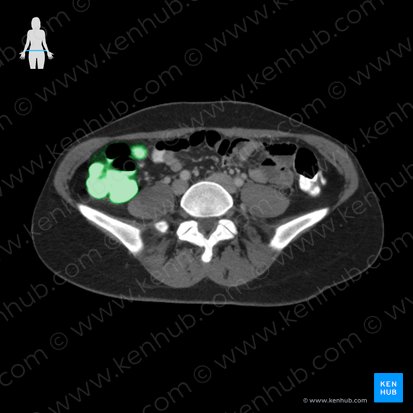 Colon ascendens (Aufsteigender Dickdarm); Bild: 
