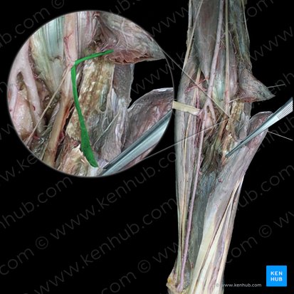 Muscular branches of median nerve to flexor carpi radialis muscle (Rami musculares nervi mediani cum musculus flexor carpi radialis); Image: 