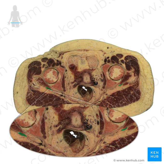 Musculus piriformis (Birnenförmiger Muskel); Bild: National Library of Medicine