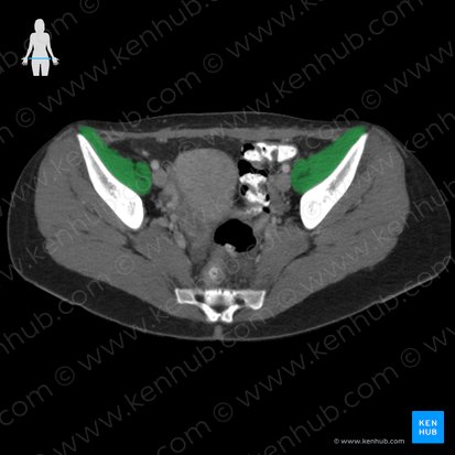 Musculus iliopsoas (Darmbein-Lenden-Muskel); Bild: 