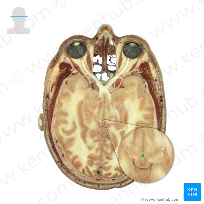 Commissura posterior (Hintere Kommissur); Bild: National Library of Medicine