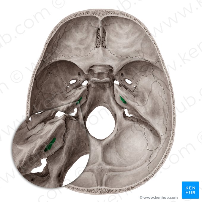 Internal acoustic meatus (Meatus acusticus internus); Image: Yousun Koh