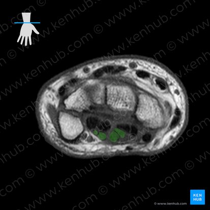 Tendons of flexor digitorum superficialis muscle (Tendines musculi flexoris digitorum superficialis); Image: 