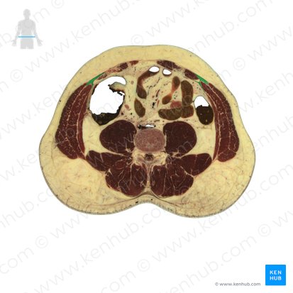 Linea semilunaris; Bild: National Library of Medicine