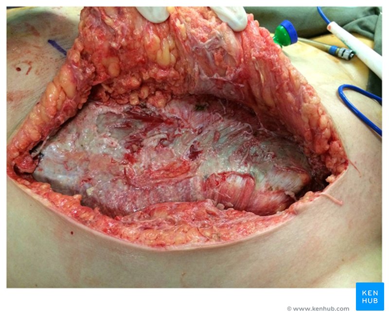 Intraoperative view of fasciitis before debridement