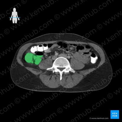 Colon ascendens (Aufsteigender Dickdarm); Bild: 
