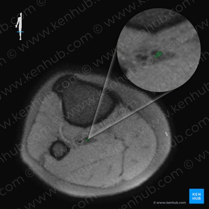 Posterior tibial veins (Venae tibiales posteriores); Image: 