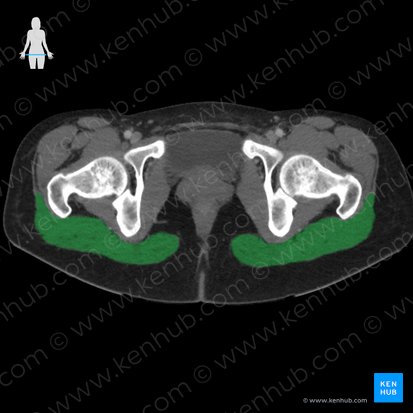 Gluteus maximus muscle (Musculus gluteus maximus); Image: 