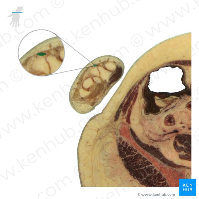 Tendon of extensor carpi radialis longus muscle (Tendo musculi extensoris carpi radialis longi); Image: National Library of Medicine