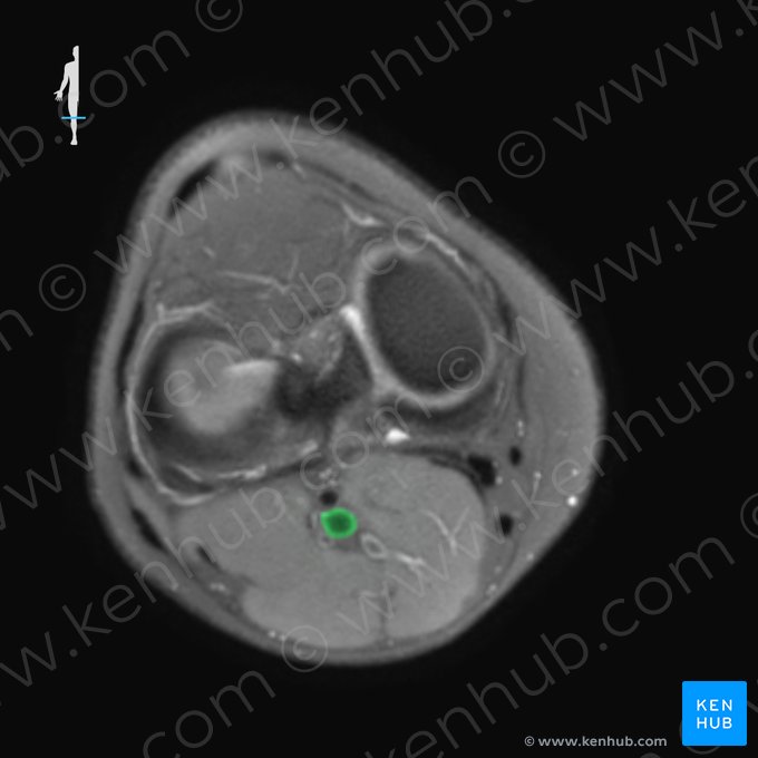 Popliteal vein (Vena poplitea); Image: 