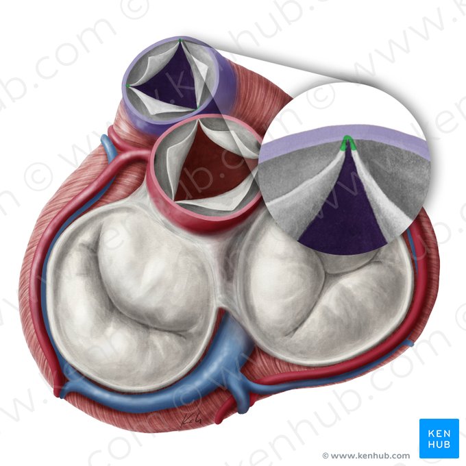 Commissures of semilunar leaflets of pulmonary valve (Commissurae valvularum semilunarium valvae trunci pulmonalis); Image: Yousun Koh