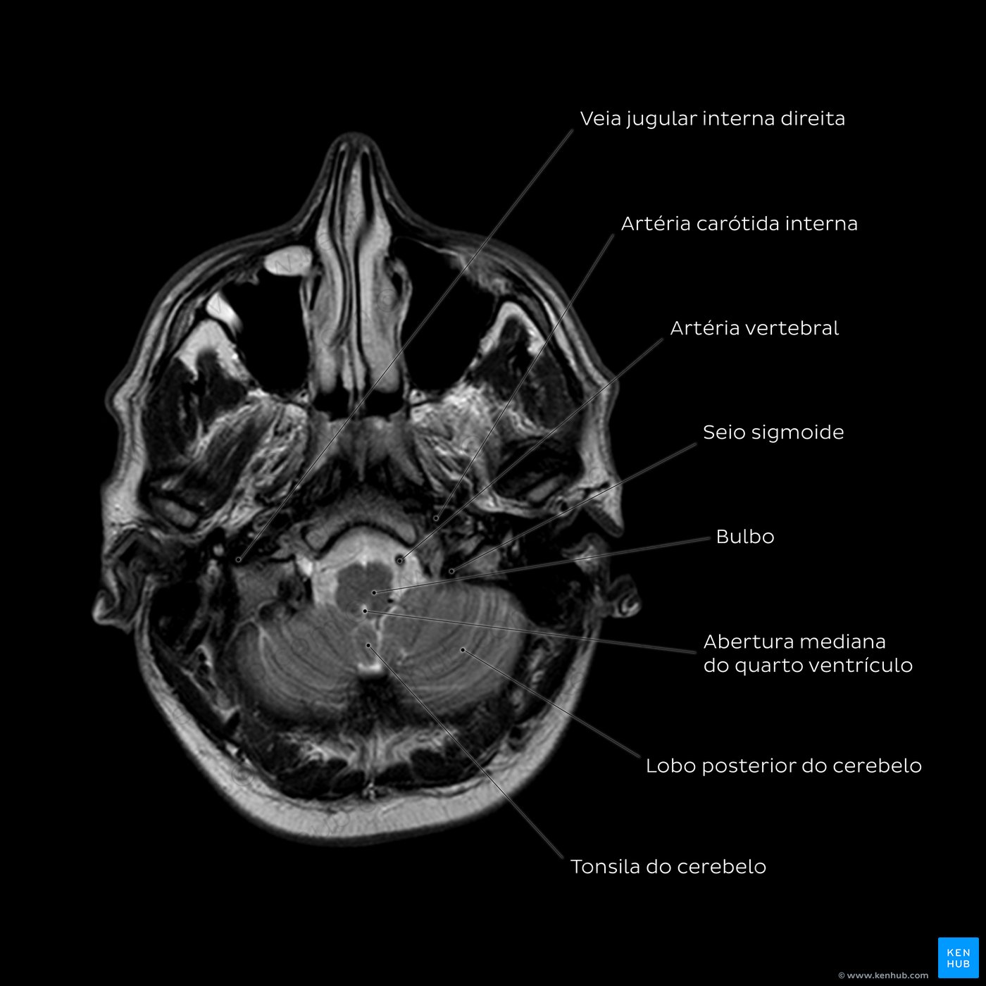 Brain MRI (cerebellum level)
