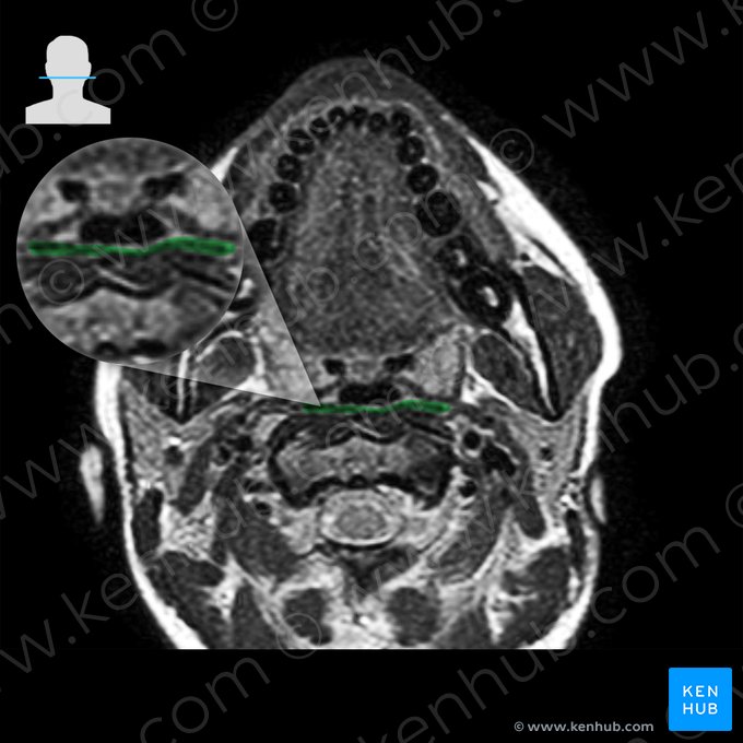 Middle pharyngeal constrictor muscle (Musculus constrictor medius pharyngis); Image: 