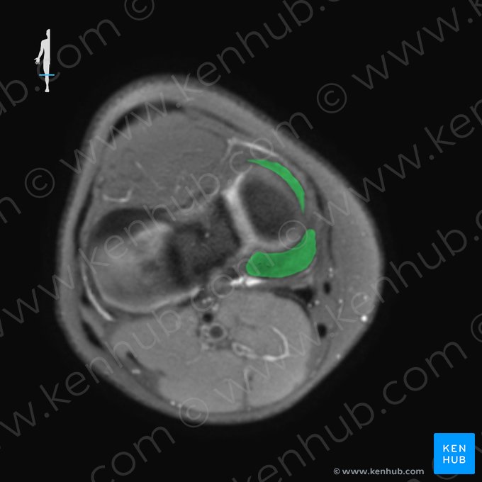 Medial meniscus (Meniscus medialis); Image: 