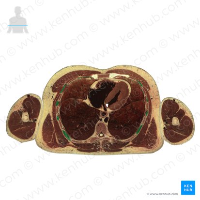 Músculos intercostales externos (Musculi intercostales externi); Imagen: National Library of Medicine
