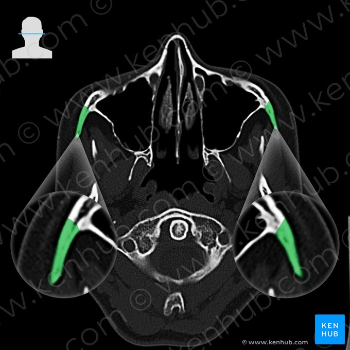 Zygomatic bone (Os zygomaticum); Image: 