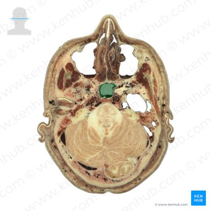Sinus sphenoidalis (Keilbeinhöhle); Bild: National Library of Medicine