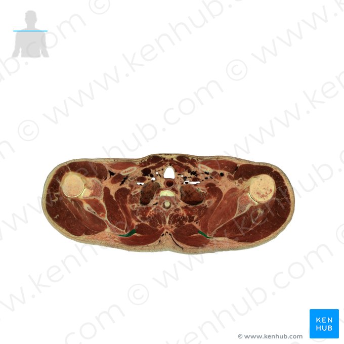 Musculus rhomboideus minor (Kleiner Rautenmuskel); Bild: National Library of Medicine