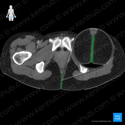 Hendidura interglútea (Crena interglutealis); Imagen: 