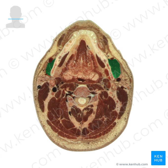 Masseter muscle (Musculus masseter); Image: National Library of Medicine