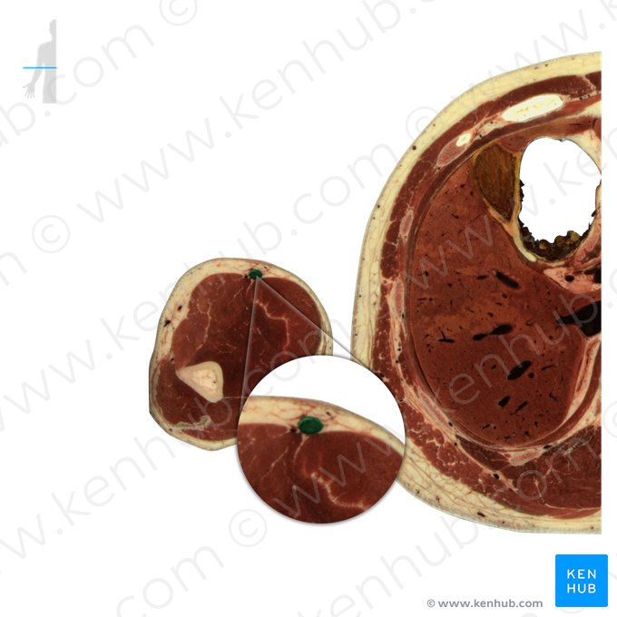 Veia cefálica (Vena cephalica); Imagem: National Library of Medicine