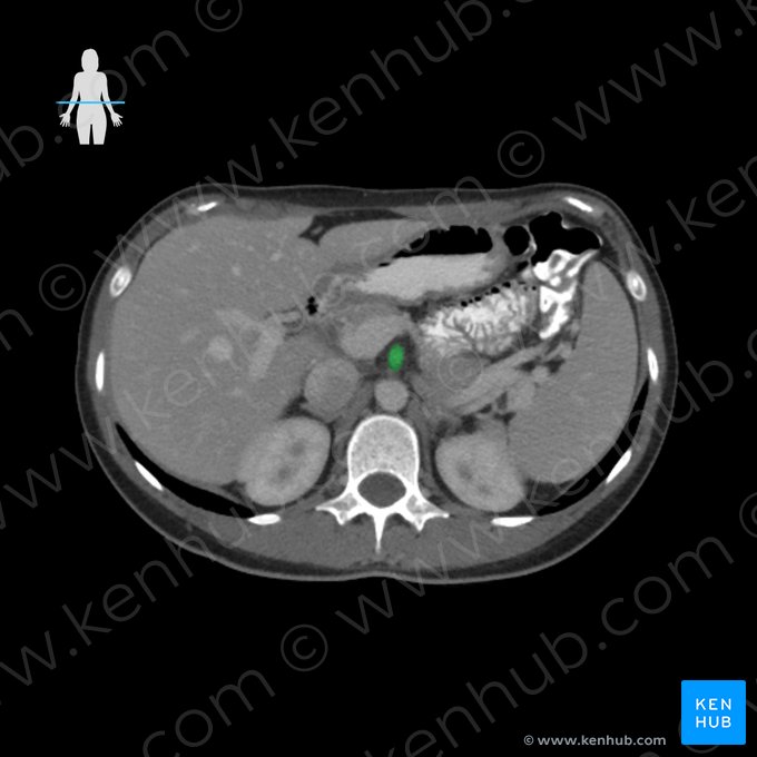 Superior mesenteric artery (Arteria mesenterica superior); Image: 