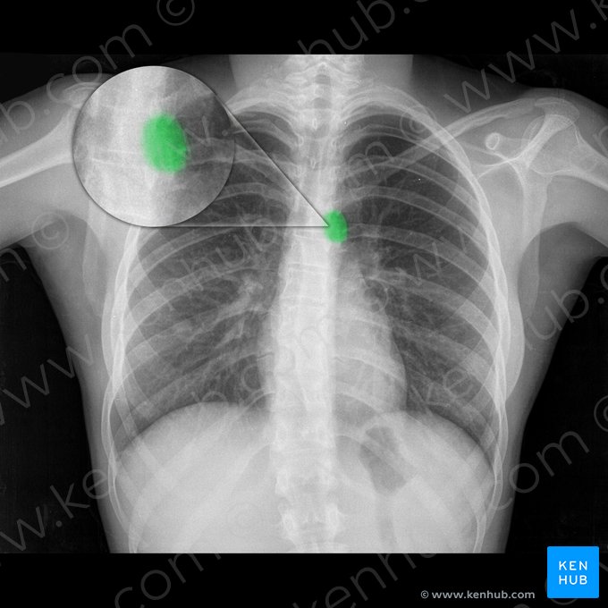 Aortic knob; Image: 