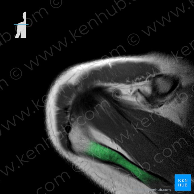 Spina scapulae (Schultergräte); Bild: 