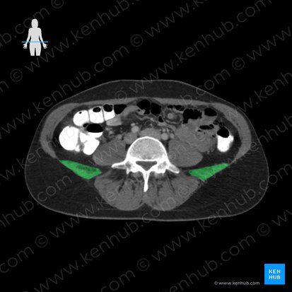 Musculus quadratus lumborum (Viereckiger Lendenmuskel); Bild: 