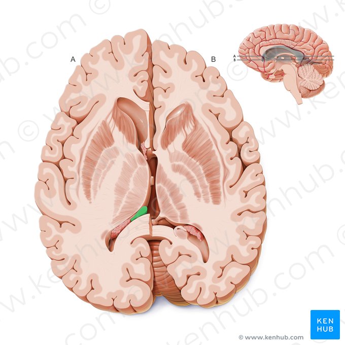 Crus of fornix (Crus fornicis); Image: Paul Kim