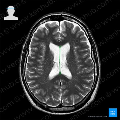 Septum pellucidum (Durchsichtige Scheidewand); Bild: 