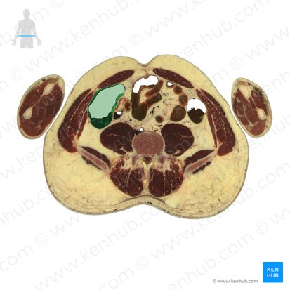 Colon ascendens (Aufsteigender Dickdarm); Bild: National Library of Medicine