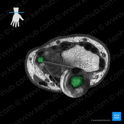 Ulna; Image: 
