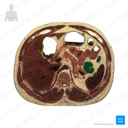 Colon descendens (Absteigender Dickdarm); Bild: National Library of Medicine