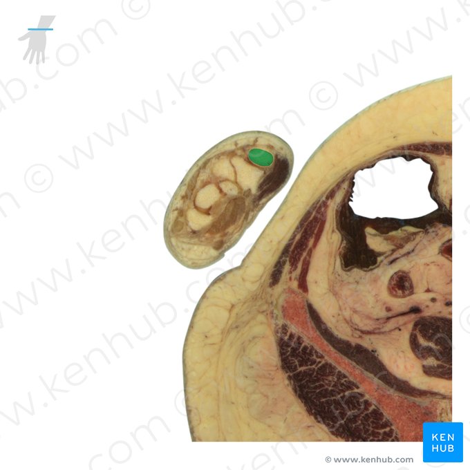 Base of 1st metacarpal bone (Basis ossis metacarpi 1); Image: National Library of Medicine