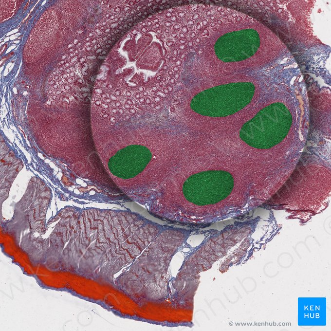 Aggregated lymphoid nodules of ileum (Peyer's patches) (Noduli lymphoidei aggregati ilei); Image: 