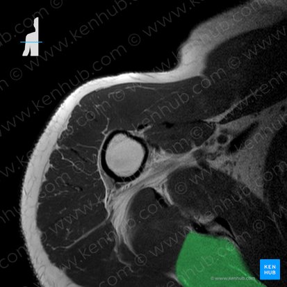 Musculus infraspinatus (Untergrätenmuskel); Bild: 