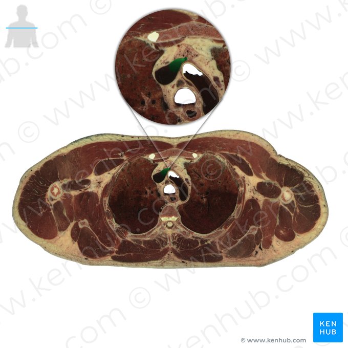 Veia braquiocefálica esquerda (Vena brachiocephalica sinistra); Imagem: National Library of Medicine