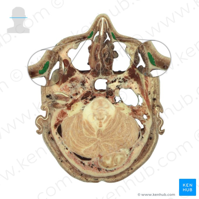 Levator labii superioris alaeque nasi muscle (Musculus levator labii superioris alaeque nasi); Image: National Library of Medicine