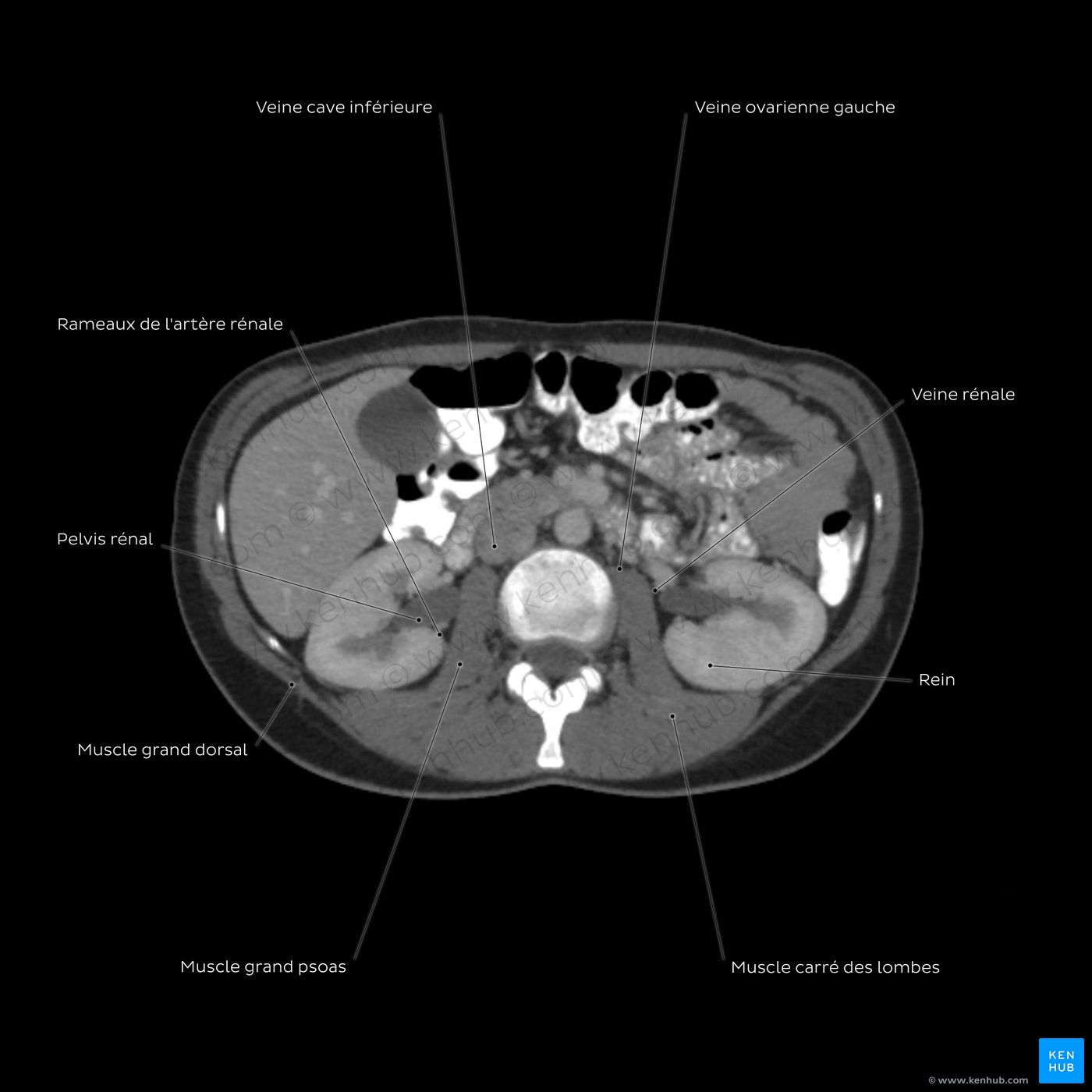 Abdominal CT overview: L3 level