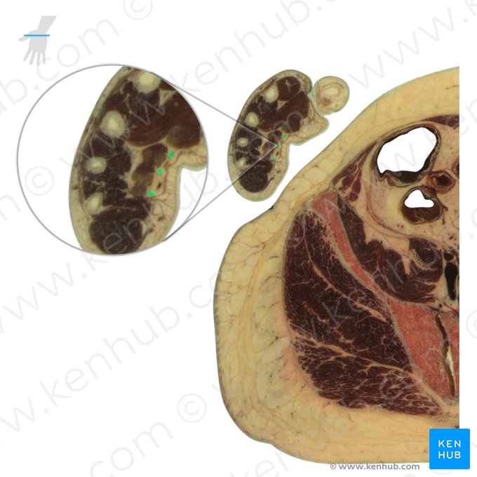 Nervi digitales palmares communes (Gemeinsame Fingernerven der Hohlhand); Bild: National Library of Medicine