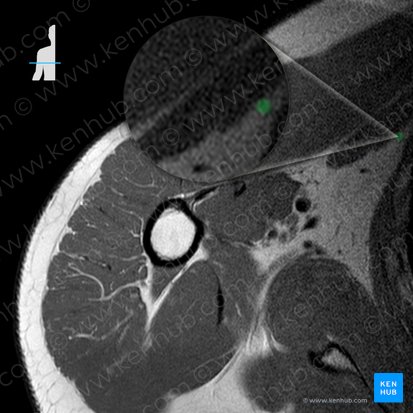 Lateral thoracic artery (Arteria thoracica lateralis); Image: 