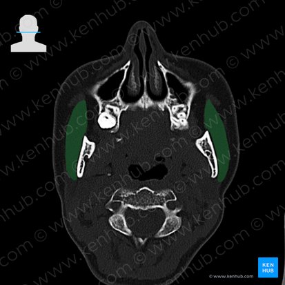 Musculus masseter (Kaumuskel); Bild: 