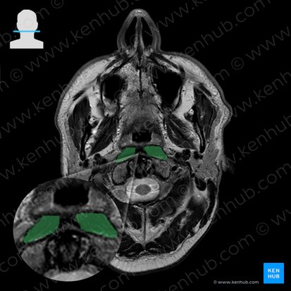 Longus capitis muscle (Musculus longus capitis); Image: 