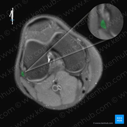 Ligamentum collaterale fibulare genus (Äußeres Kollateralband des Knies); Bild: 