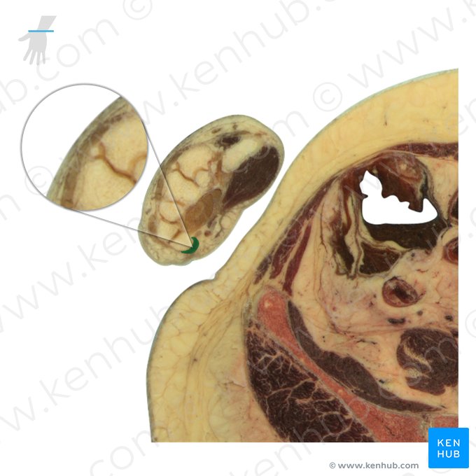 Tendon of abductor digiti minimi muscle (Tendo musculi abductoris digiti minimi); Image: National Library of Medicine
